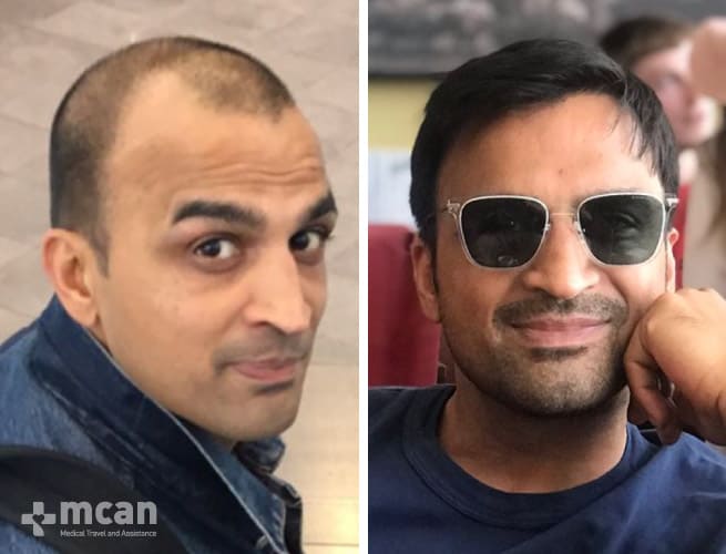 Hair Transplant - Before After 12