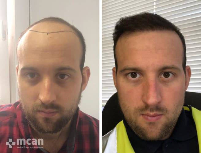 FUE hair transplant before and after