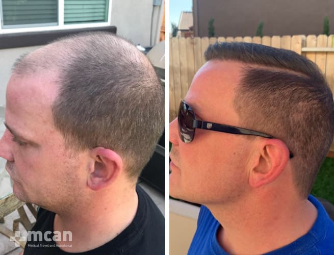 Early hair transplant results before and after
