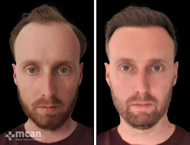 Hair Transplant - Before After 17