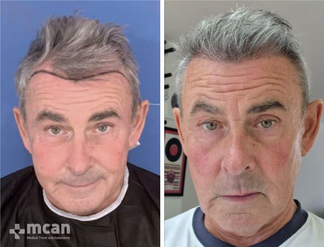 After a hair transplant in Istanbul, Turkey