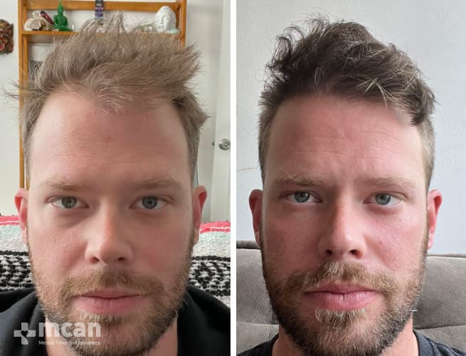 Favorable hair transplant before and afters