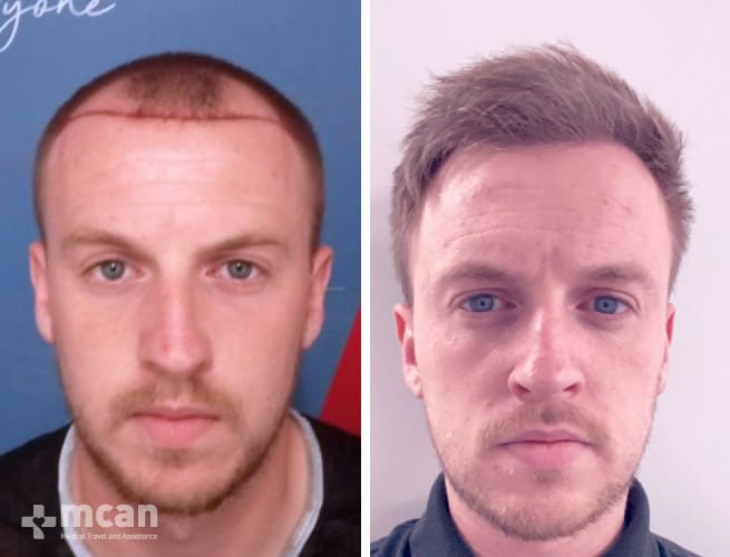 Hair Transplant - Before After 21