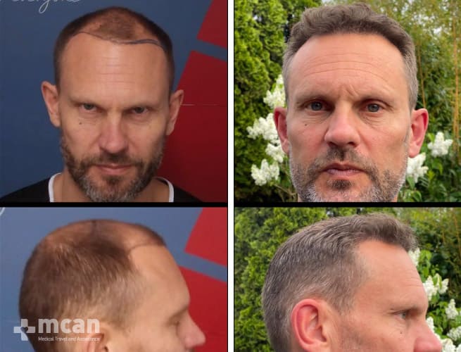 Impeccable effect of a hair transplantation