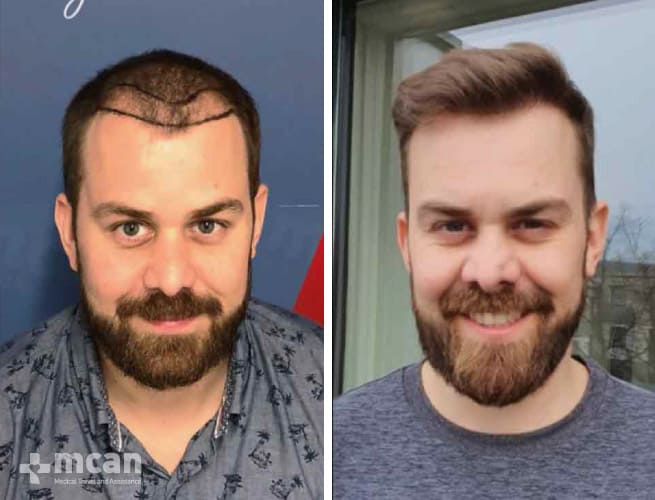 Best Hair Transplant Turkey - Istanbul 2023 | All Included Packages