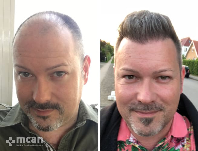 Successful after a hair transplant photo
