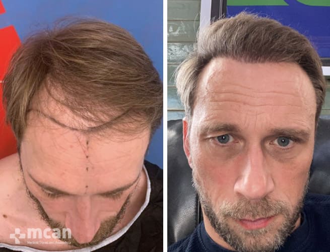 Before and after a hair transplant in Istanbul, Turkey