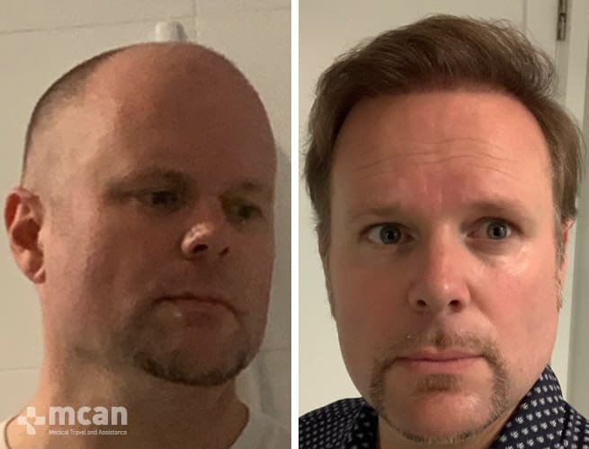 Hair Transplant - Before After 8