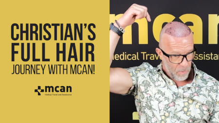 Christians volle Haartransplantationsreise mit Mcan