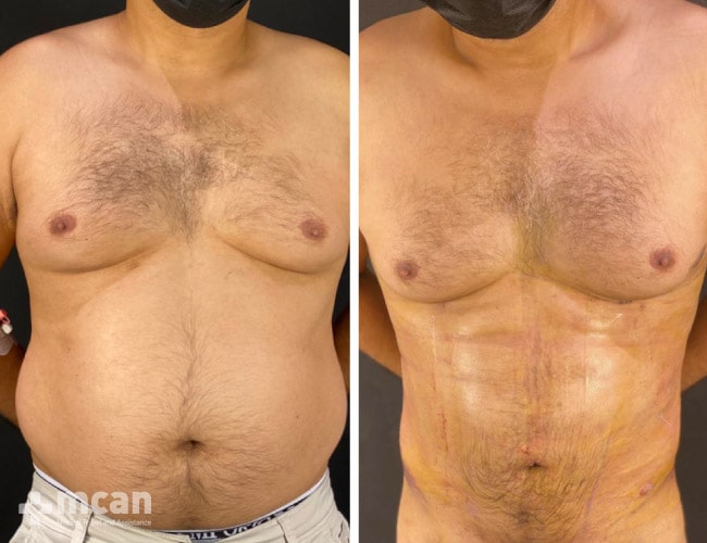 lipoescultura masculina fotografía del antes y el después