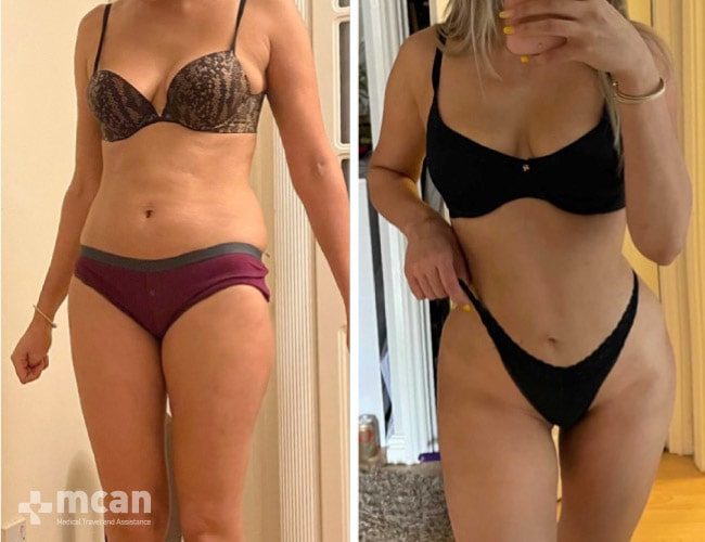 foto de lipoescultura antes y después con resultados extraordinarios