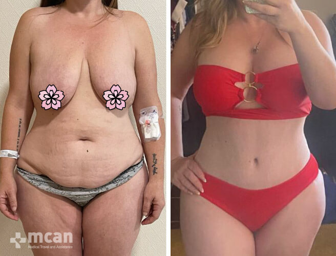 Tummy Tuck in Turkey Before and After photos0