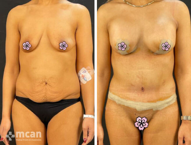 Abdominoplasty in Turkey