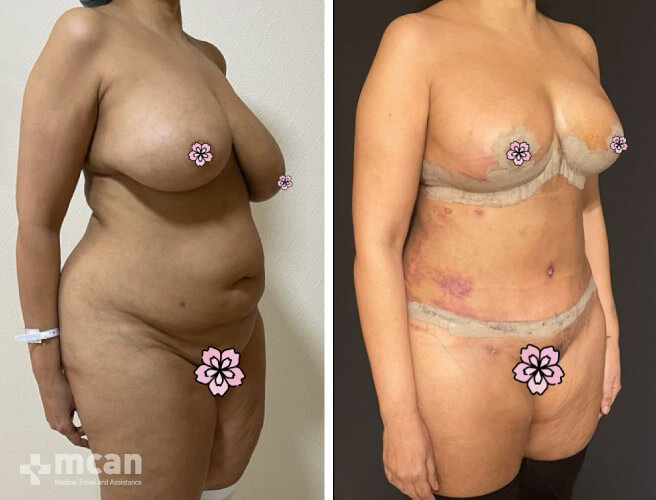 Tummy Tuck in Turkey Before and After photos12