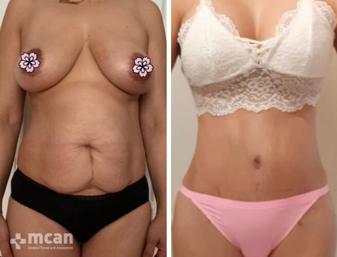 Tummy tuck with liposuction