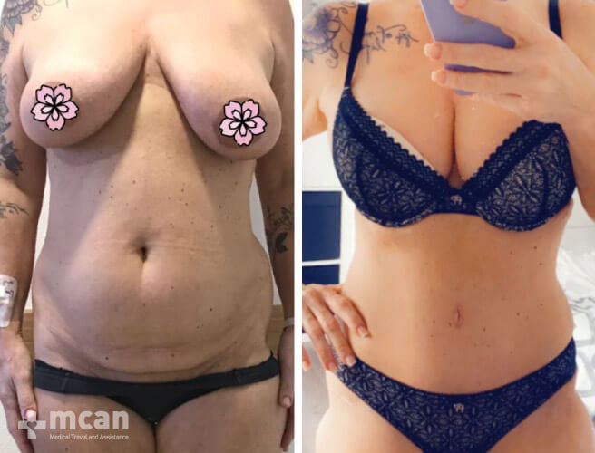 Firmer look with abdominoplasty