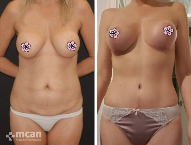 Tummy Tuck in Turkey Before and After photos15