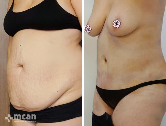 Tummy Tuck in Turkey Before and After photos16