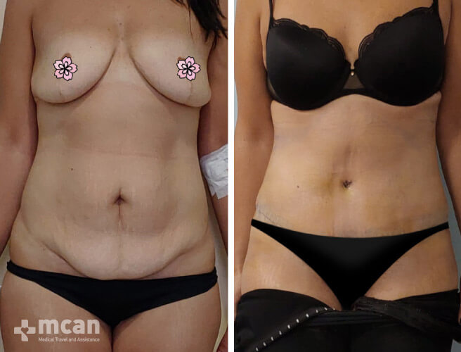 Tummy Tuck in Turkey Before and After photos17