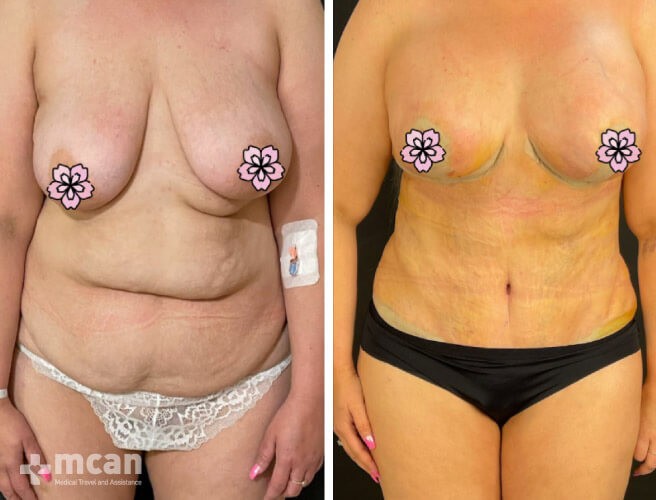 Tummy Tuck in Turkey Before and After photos18