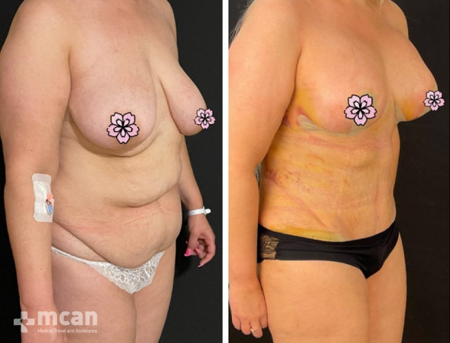 Tummy Tuck in Turkey Before and After photos19
