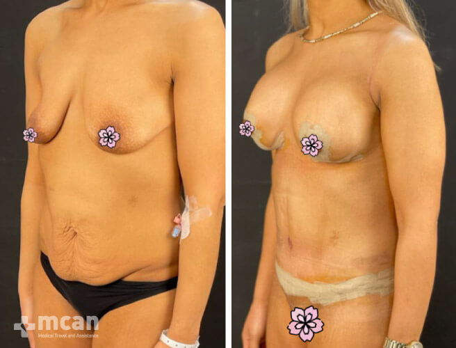 Tummy Tuck Turkey before and after