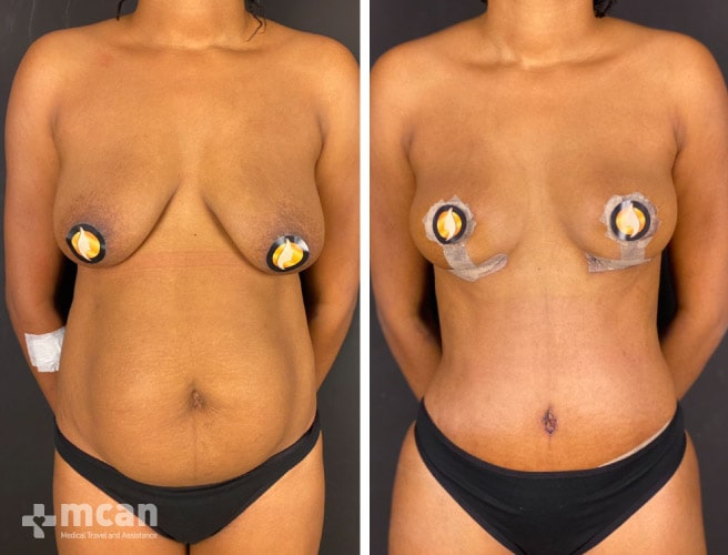 Tummy Tuck in Turkey Before and After photos20