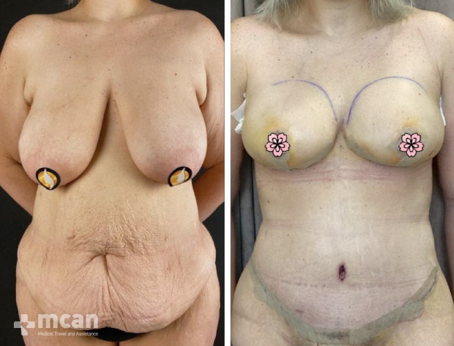 tummy tuck surgery in turkey