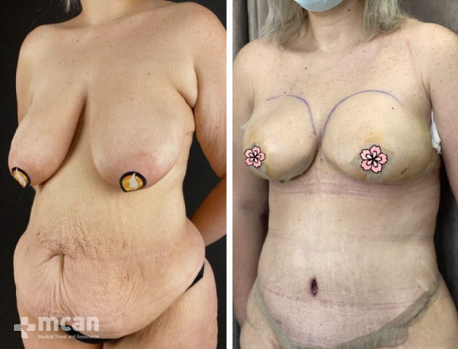 Tummy Tuck in Turkey Before and After photos22