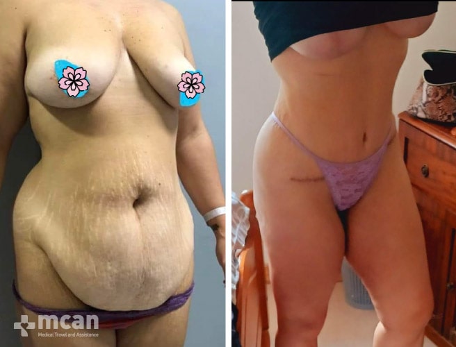 Tummy Tuck in Turkey Before and After photos24