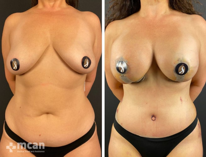 Tummy Tuck in Turkey Before and After photos25