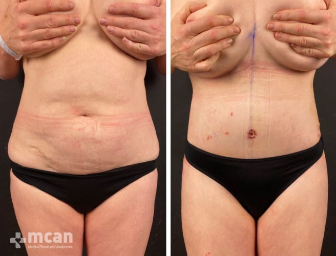 outstanding tummy tuck procedure