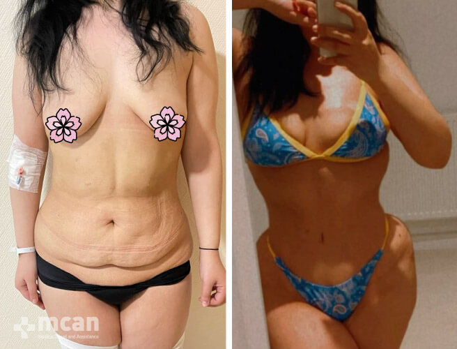 remarkable before and after tummy tuck