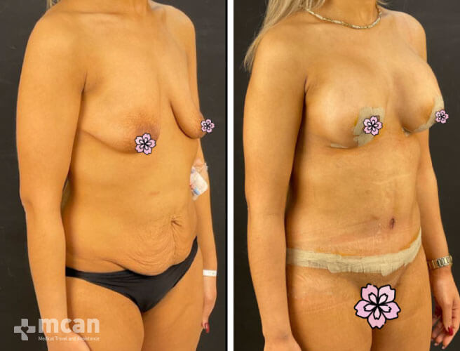 Tummy Tuck procedure results