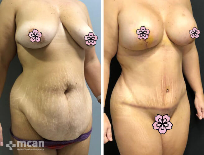 Tummy Tuck in Turkey Before and After photos4