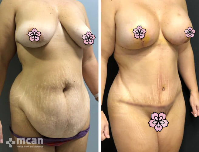 Tummy Tuck procedure results