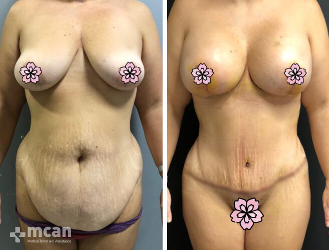 Tummy Tuck in Turkey Before and After photos5