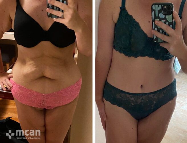 Tummy Tuck in Turkey Before and After photos7