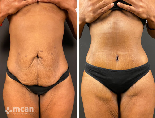 after abdominoplasty in Turkey