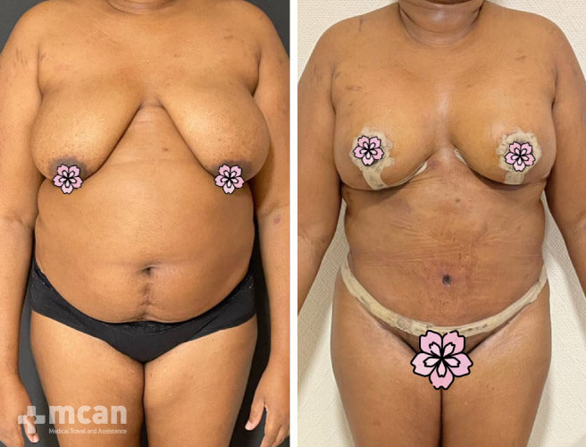 Tummy Tuck in Turkey Before and After photos9