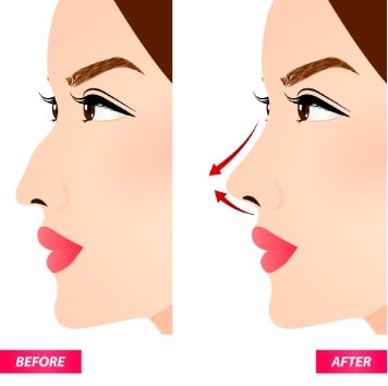 Revision Rhinoplasty