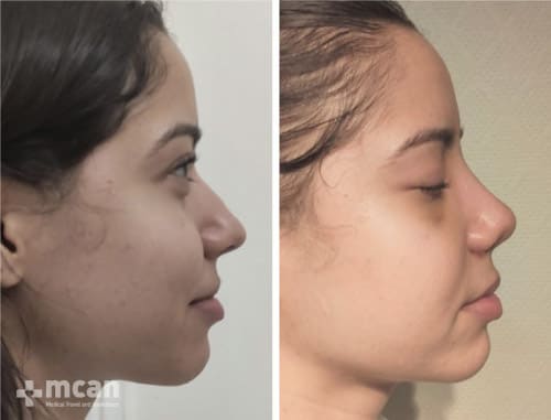 nose reshaping - before after