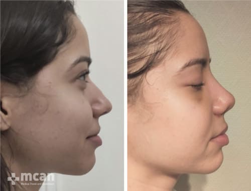 Transformation with rhinoplasty