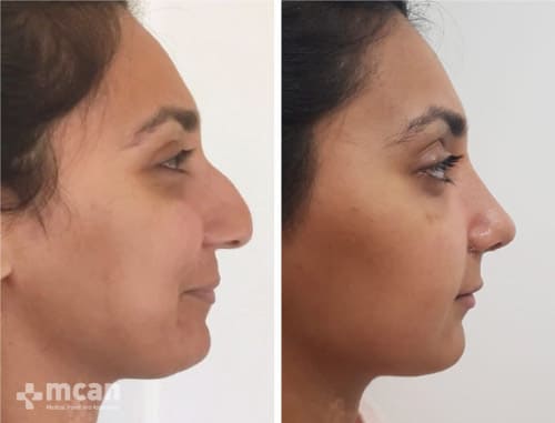 Rhinoplasty Istanbul recovery before and after