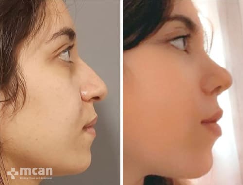 vor und nach einer Nasenoperation