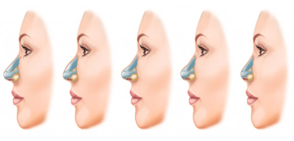 Different Types of Nose Surgery