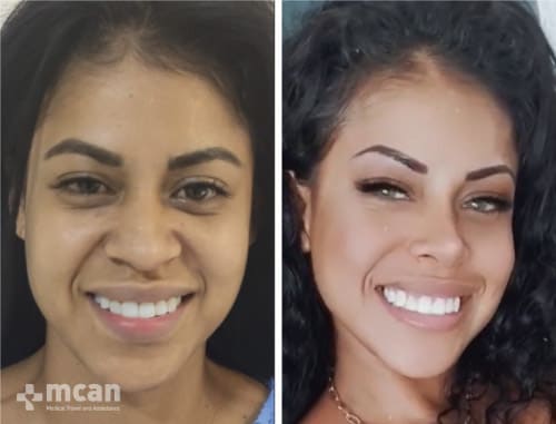 ethnic nose job before and after