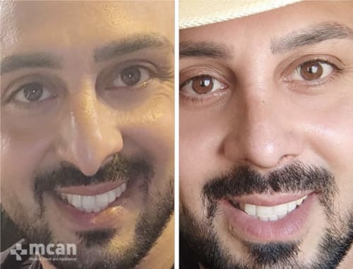 Male Nose Job - Before After
