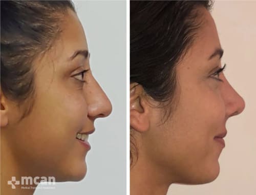 nose job before after