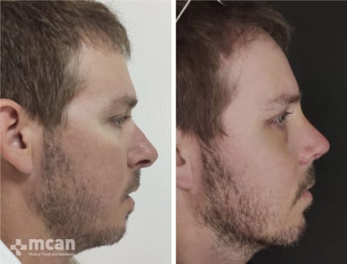 Rhinoplasty results